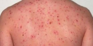 El sarampión, en recrudecimiento a nivel mundial
